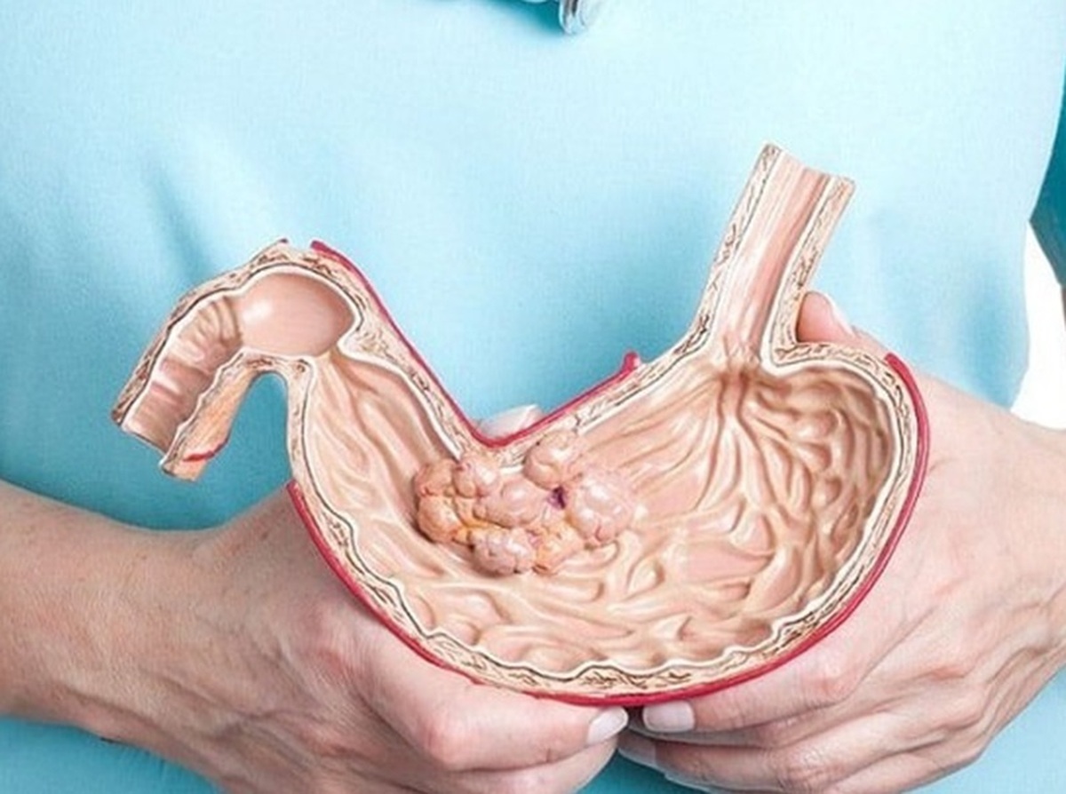 آیا بوتاکس معده واقعاً مؤثر است؟ بررسی علمی و تجربی در کلینیک‌های تهران